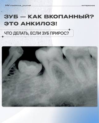 Анкилоз зуба: когда пульпа замещается костью.